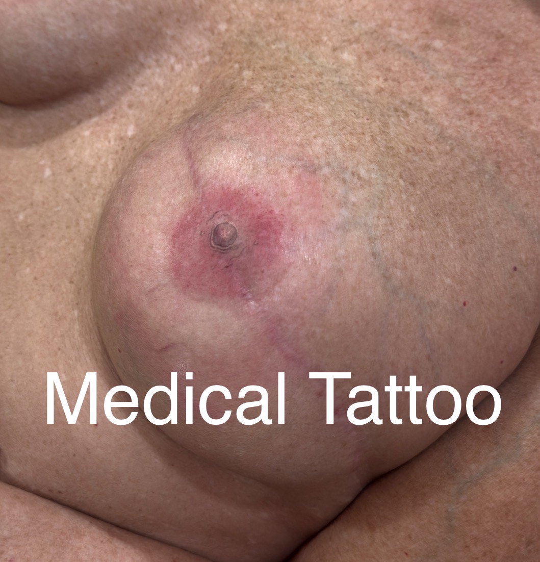 Medical Tattooing in Lafayette, LA